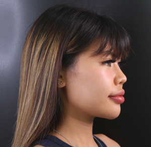 ฟิลเลอร์แก้มส้ม (Mid Cheek Filler)