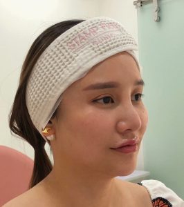 โบท็อกซ์ลดริ้วรอย (Botulinum Toxin)