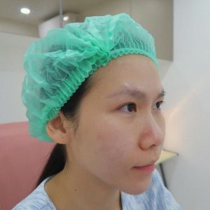 ร้อยไหมยกกระชับใบหน้า