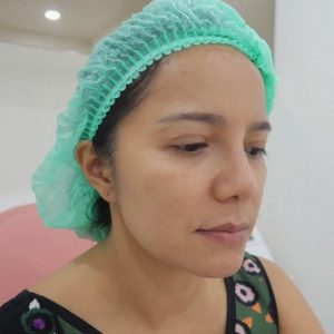 ร้อยไหมจมูก