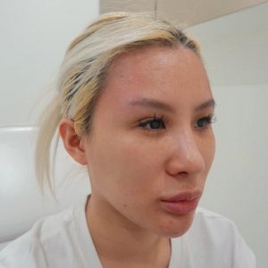 ร้อยไหมยกคิ้ว