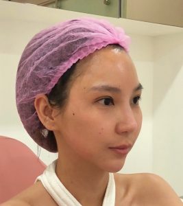 โบท็อกซ์ลิฟกรอบคอระหงษ์ (Nefertiti Botox)