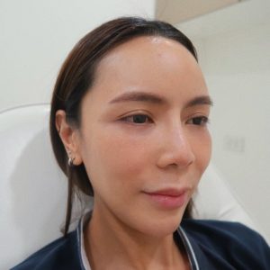 โบท็อกซ์ลดปีกจมูก (Reduces Nose Botox)