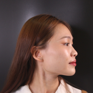 ฟิลเลอร์ยกกระชับ (Filler Lift)