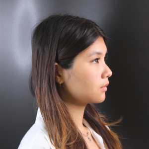 ฟิลเลอร์ใต้ตา (Under eye Filler)